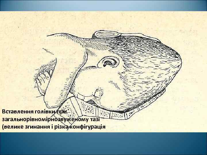 Вставлення голівки при загальнорівномірнозвуженому тазі (велике згинання і різка конфігурація 
