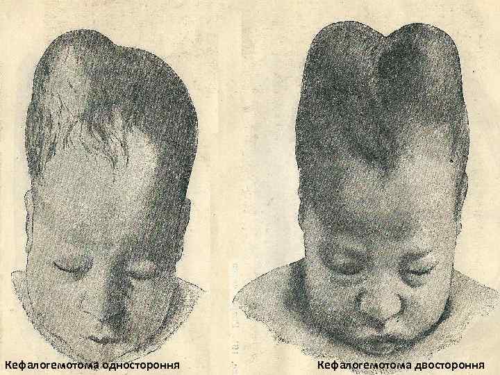 Кефалогемотома одностороння Кефалогемотома двостороння 