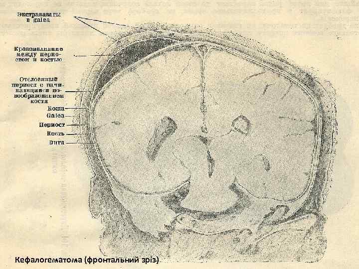 Кефалогематома (фронтальний зріз) 