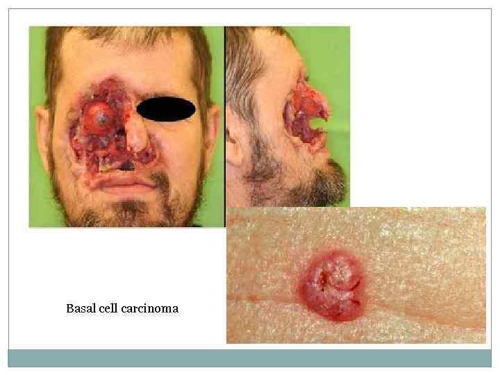 Basal cell carcinoma 