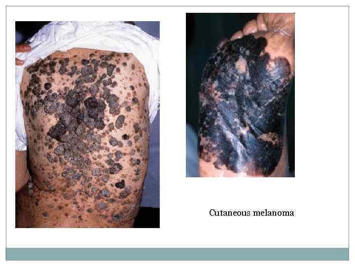 Cutaneous melanoma 