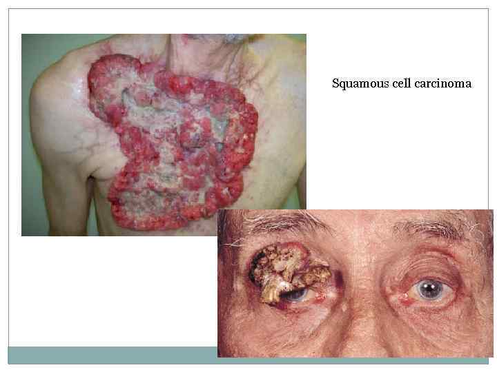 Squamous cell carcinoma 