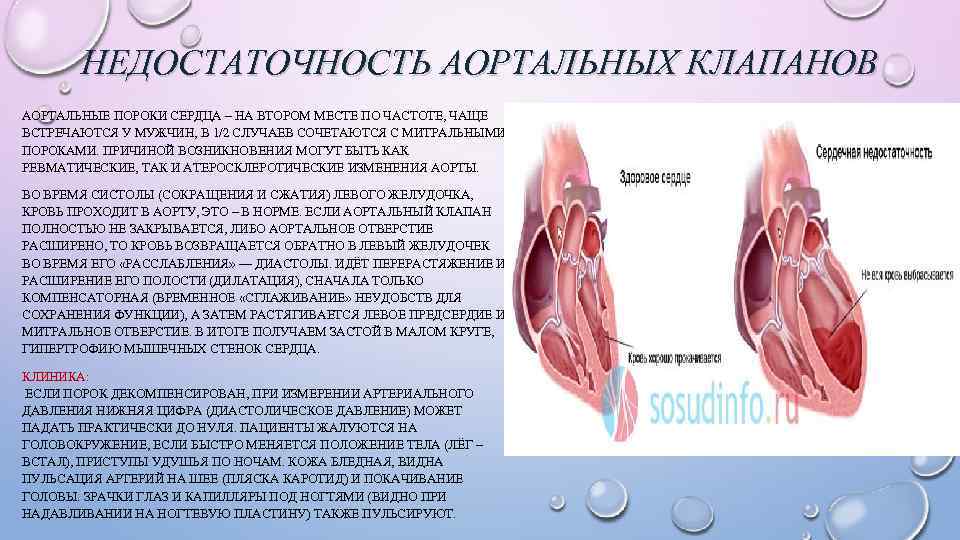 НЕДОСТАТОЧНОСТЬ АОРТАЛЬНЫХ КЛАПАНОВ АОРТАЛЬНЫЕ ПОРОКИ СЕРДЦА – НА ВТОРОМ МЕСТЕ ПО ЧАСТОТЕ, ЧАЩЕ ВСТРЕЧАЮТСЯ