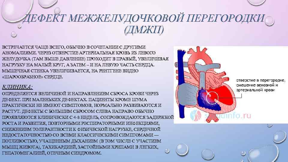 ДЕФЕКТ МЕЖЖЕЛУДОЧКОВОЙ ПЕРЕГОРОДКИ (ДМЖП) ВСТРЕЧАЕТСЯ ЧАЩЕ ВСЕГО, ОБЫЧНО В СОЧЕТАНИИ С ДРУГИМИ АНОМАЛИЯМИ. ЧЕРЕЗ