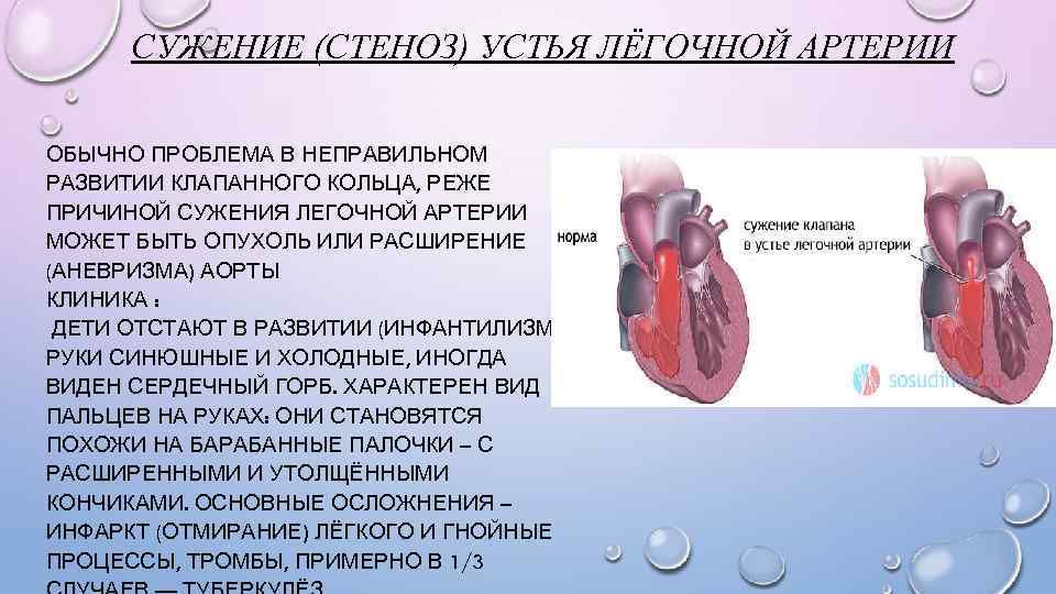 СУЖЕНИЕ (СТЕНОЗ) УСТЬЯ ЛЁГОЧНОЙ АРТЕРИИ ОБЫЧНО ПРОБЛЕМА В НЕПРАВИЛЬНОМ РАЗВИТИИ КЛАПАННОГО КОЛЬЦА, РЕЖЕ ПРИЧИНОЙ