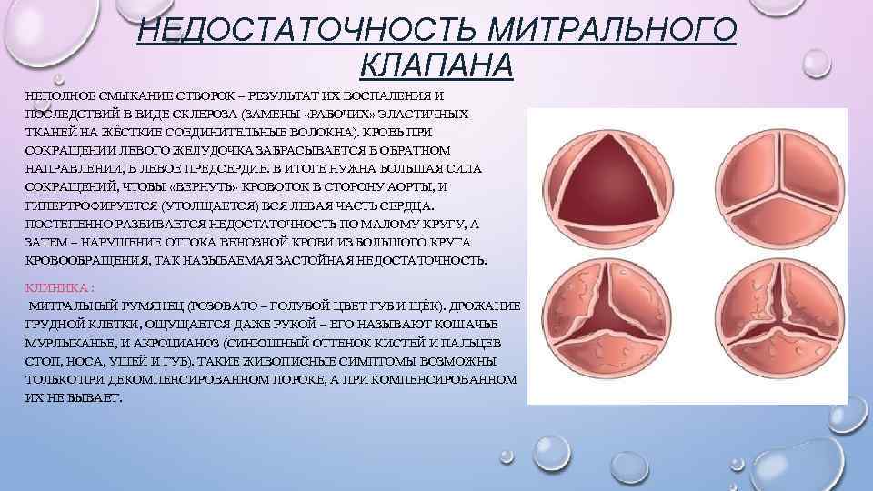 НЕДОСТАТОЧНОСТЬ МИТРАЛЬНОГО КЛАПАНА НЕПОЛНОЕ СМЫКАНИЕ СТВОРОК – РЕЗУЛЬТАТ ИХ ВОСПАЛЕНИЯ И ПОСЛЕДСТВИЙ В ВИДЕ