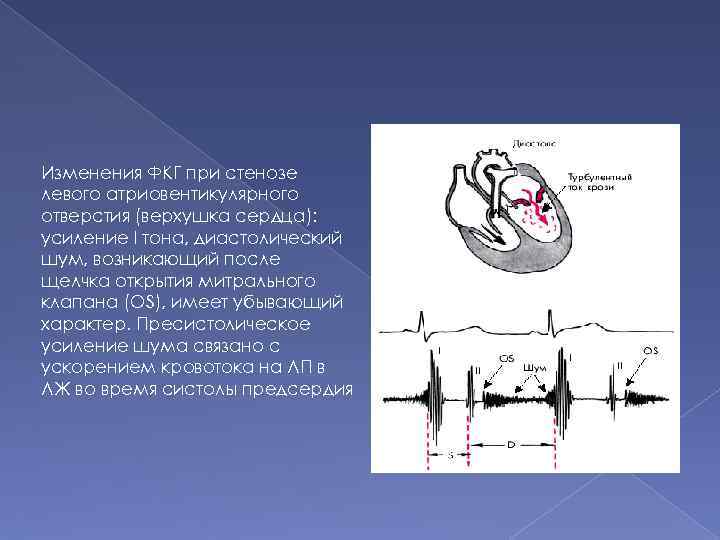 Изменения ФКГ при стенозе левого атриовентикулярного отверстия (верхушка сердца): усиление I тона, диастолический шум,