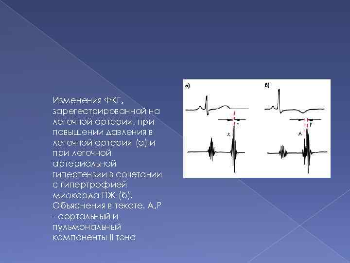 Изменения ФКГ, зарегестрированной на легочной артерии, при повышении давления в легочной артерии (а) и