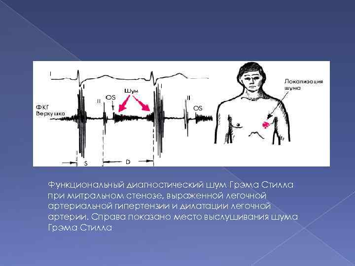 Функциональный диагностический шум Грэма Стилла при митральном стенозе, выраженной легочной артериальной гипертензии и дилатации