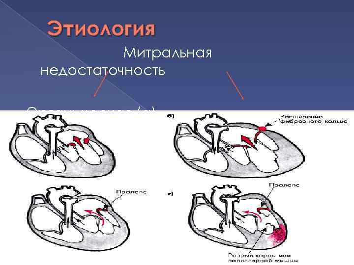 Этиология Митральная недостаточность Органическая (а) Функциональная 