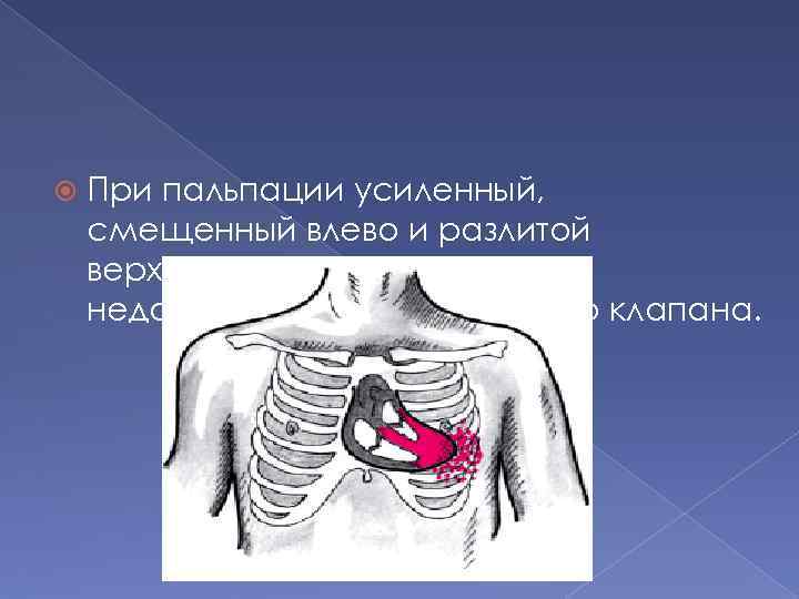  При пальпации усиленный, смещенный влево и разлитой верхушечный толчок при недостаточности митрального клапана.