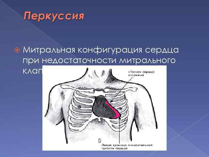 Перкуссия Митральная конфигурация сердца при недостаточности митрального клапана 