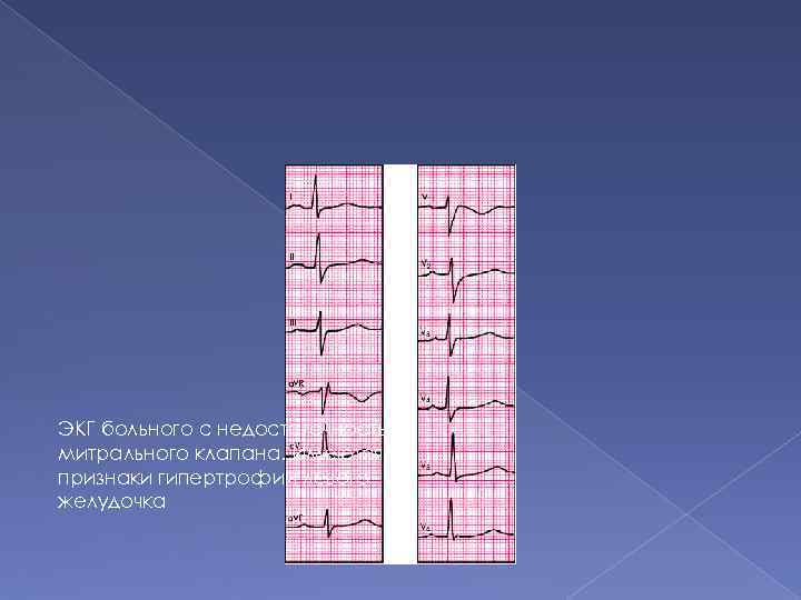 ЭКГ больного с недостаточностью митрального клапана. Имеются признаки гипертрофии левого желудочка 