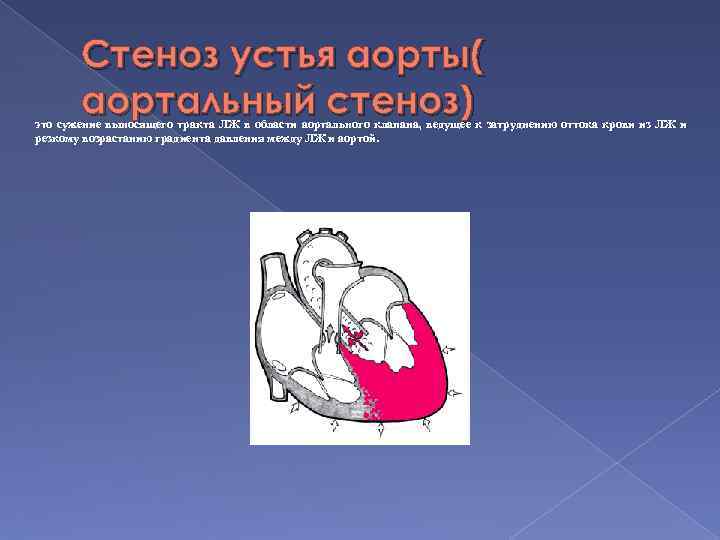 Стеноз устья аорты( аортальный стеноз) это сужение выносящего тракта ЛЖ в области аортального клапана,