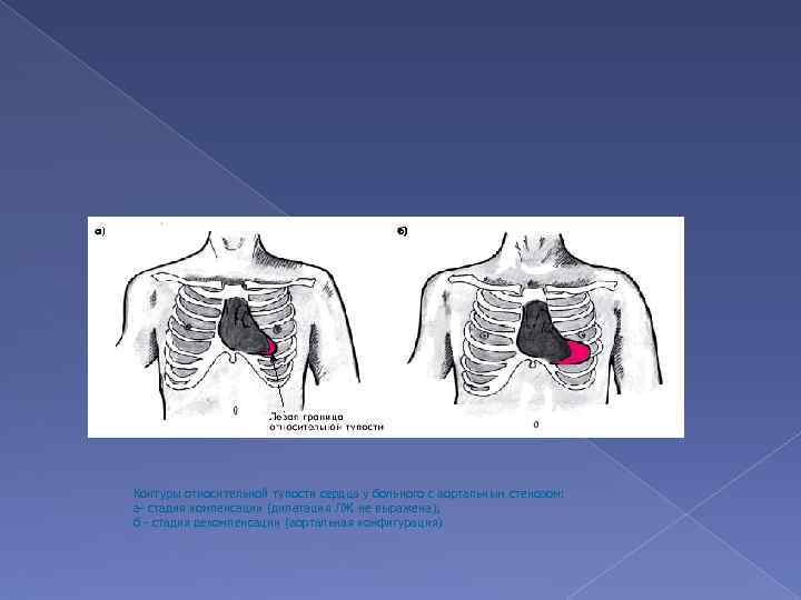 Контуры относительной тупости сердца у больного с аортальным стенозом: а- стадия компенсации (дилатация ЛЖ