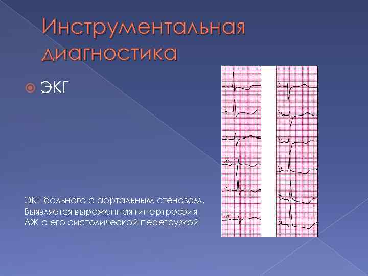 Инструментальная диагностика ЭКГ больного с аортальным стенозом. Выявляется выраженная гипертрофия ЛЖ с его систолической