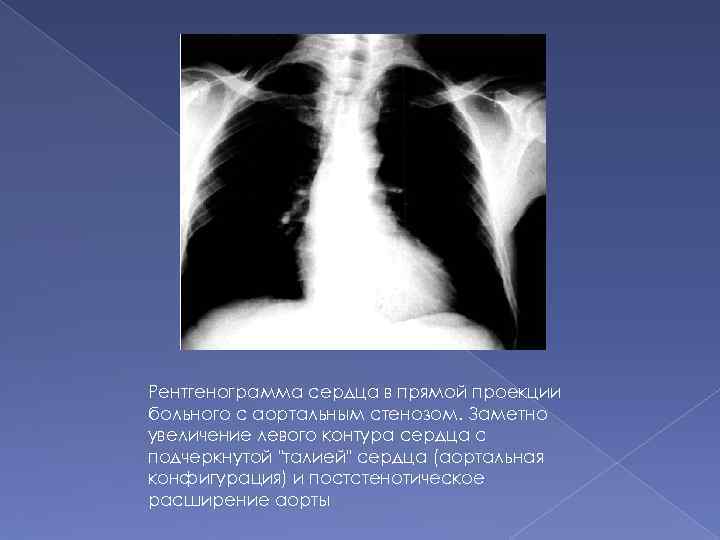 Рентгенограмма сердца в прямой проекции больного с аортальным стенозом. Заметно увеличение левого контура сердца