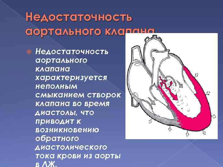 Створки аортального клапана. Стенки аорты и створки аортального клапана уплотнены. Уплотнение стенок аорты и створок аортального клапана что это такое. Недостаточность аортального клапана этиология.