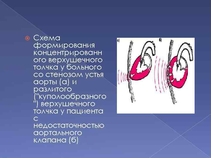  Схема формирования концентрированн ого верхушечного толчка у больного со стенозом устья аорты (а)