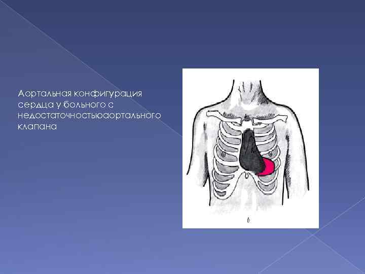 Конфигурация сердца аортальная схема