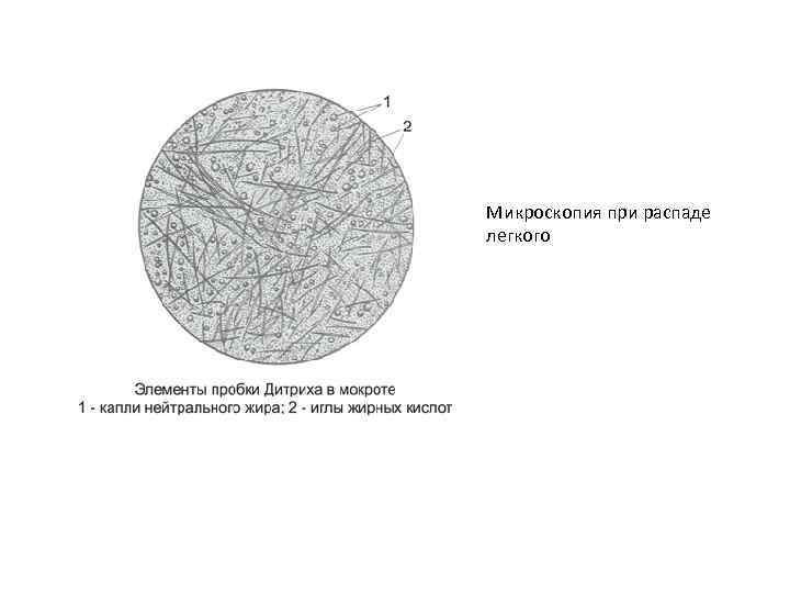 Микроскопия при распаде легкого 