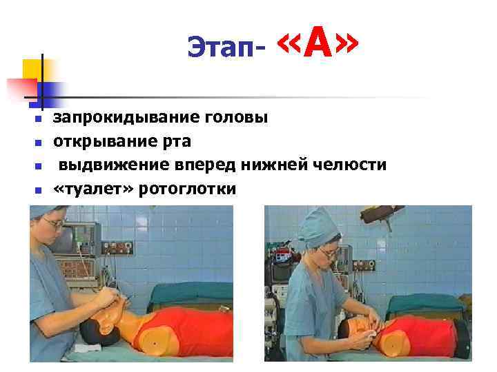 Этап- «А» n n запрокидывание головы открывание рта выдвижение вперед нижней челюсти «туалет» ротоглотки