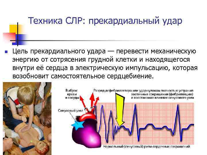 Техника СЛР: прекардиальный удар n Цель прекардиального удара — перевести механическую энергию от сотрясения