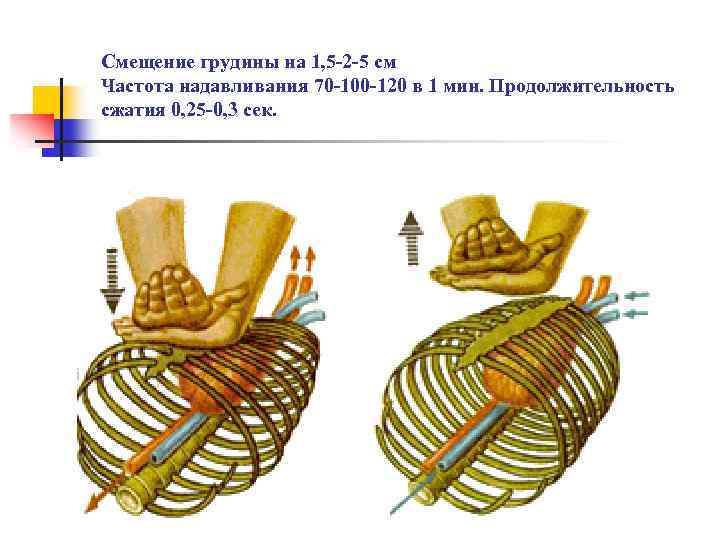Смещение грудины на 1, 5 -2 -5 см Частота надавливания 70 -100 -120 в