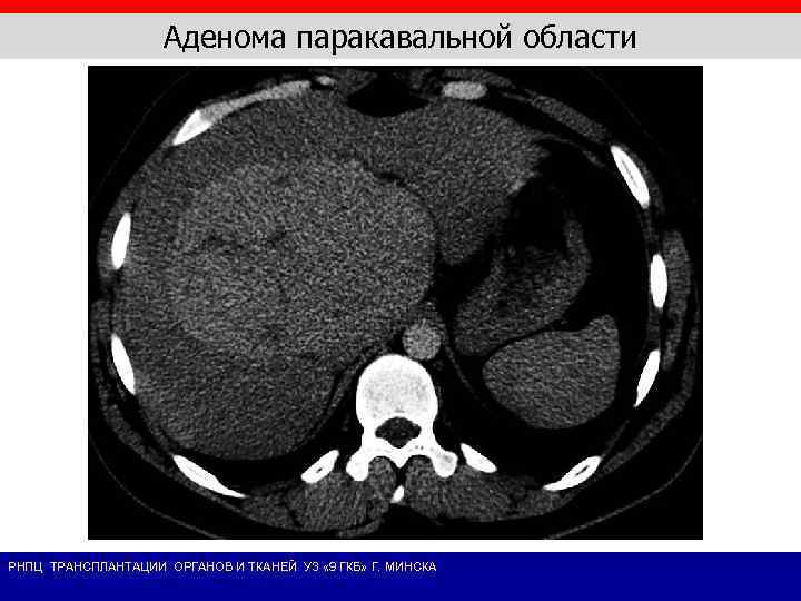 Аденома паракавальной области РНПЦ ТРАНСПЛАНТАЦИИ ОРГАНОВ И ТКАНЕЙ УЗ « 9 ГКБ» Г. МИНСКА