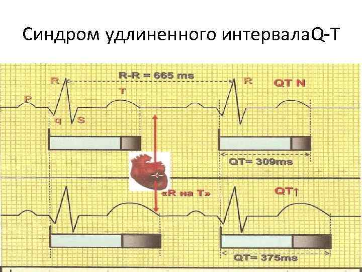 Синдром удлиненного интервала. Q-T 