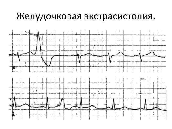 Желудочковая экстрасистолия. 