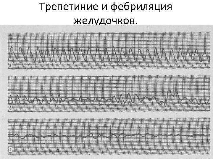 Трепетиние и фебриляция желудочков. 