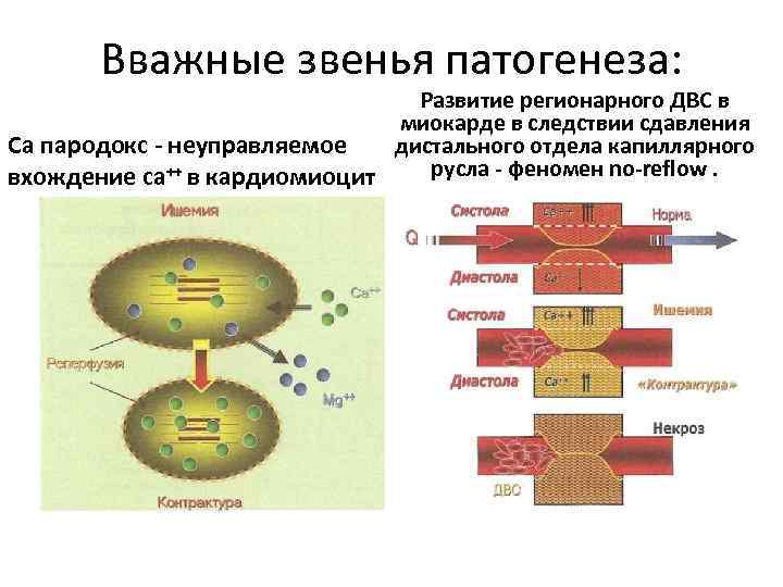 Вважные звенья патогенеза: Развитие регионарного ДВС в миокарде в следствии сдавления дистального отдела капиллярного