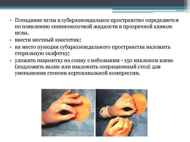  • Попадание иглы в субарахноидальное пространство определяется по появлению спинномозговой жидкости в прозрачной