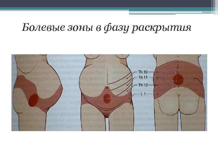 Болевые зоны в фазу раскрытия 