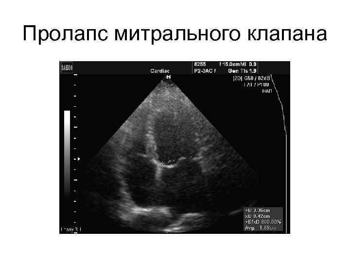 Пролапс митрального клапана 