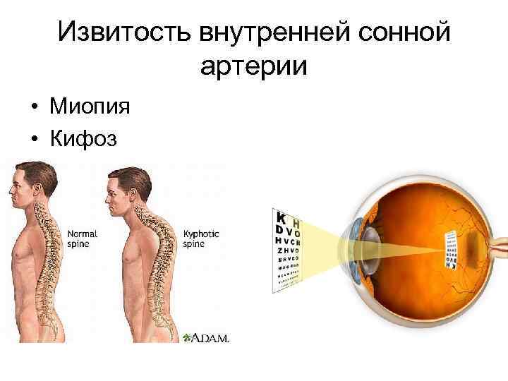 Извитость внутренней сонной артерии • Миопия • Кифоз 