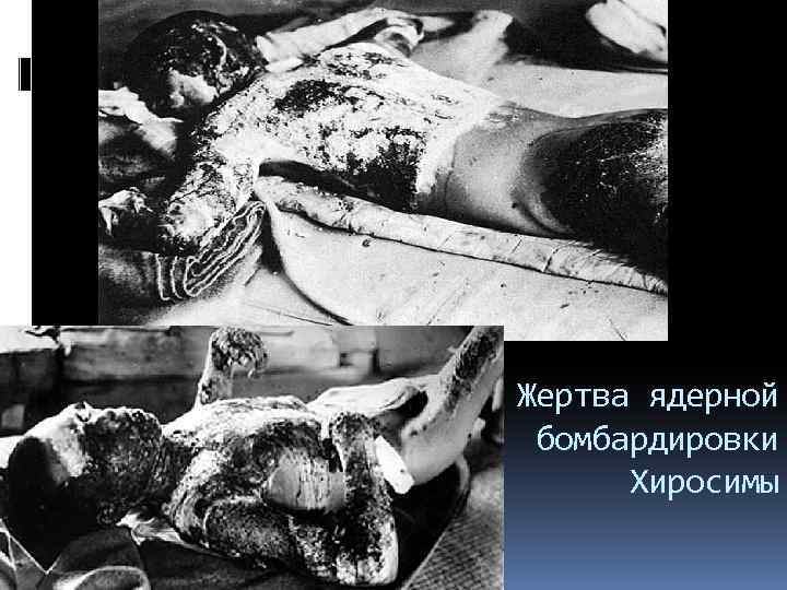 Жертва ядерной бомбардировки Хиросимы 