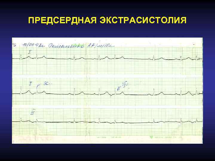 ПРЕДСЕРДНАЯ ЭКСТРАСИСТОЛИЯ 