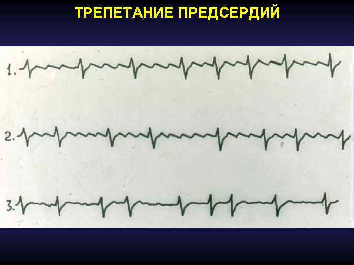 Аритмии и блокады сердца презентация