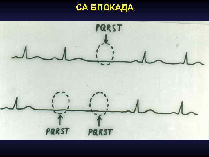 Са блокада. Аритмии и блокады атлас. Уровни блокады сердца.