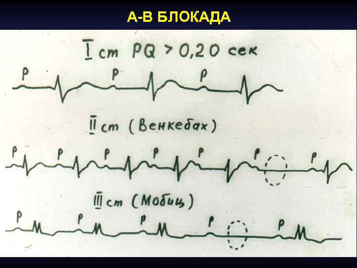 Аритмии и блокады сердца презентация