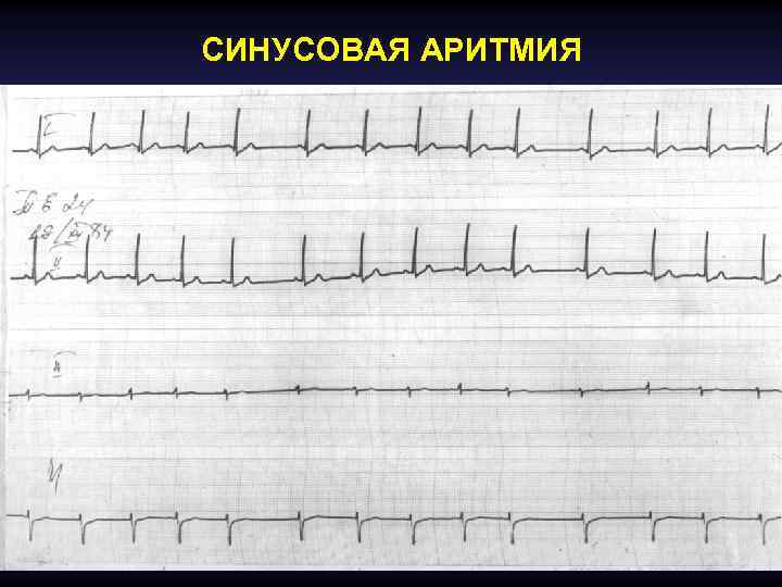 СИНУСОВАЯ АРИТМИЯ 