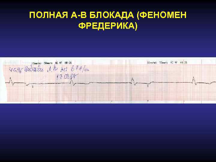 ПОЛНАЯ А-В БЛОКАДА (ФЕНОМЕН ФРЕДЕРИКА) 