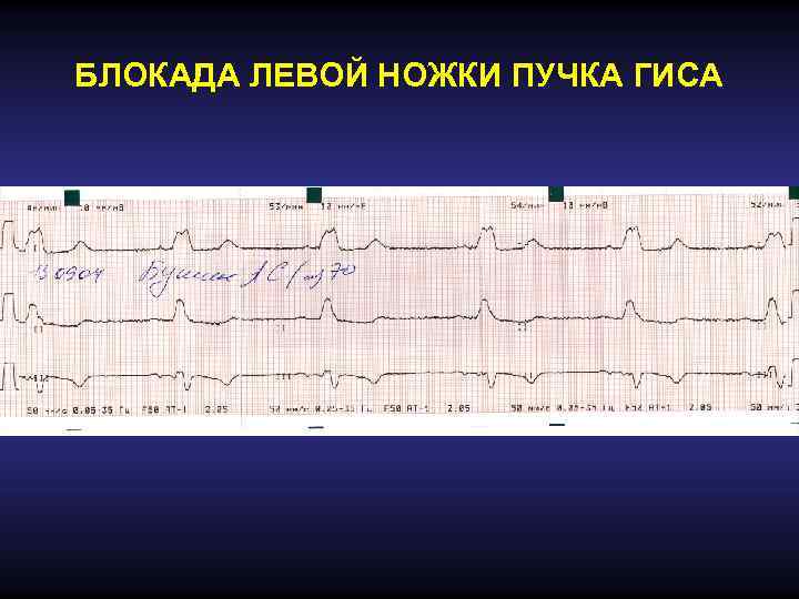 Экг блокада левой ножки пучка гиса фото