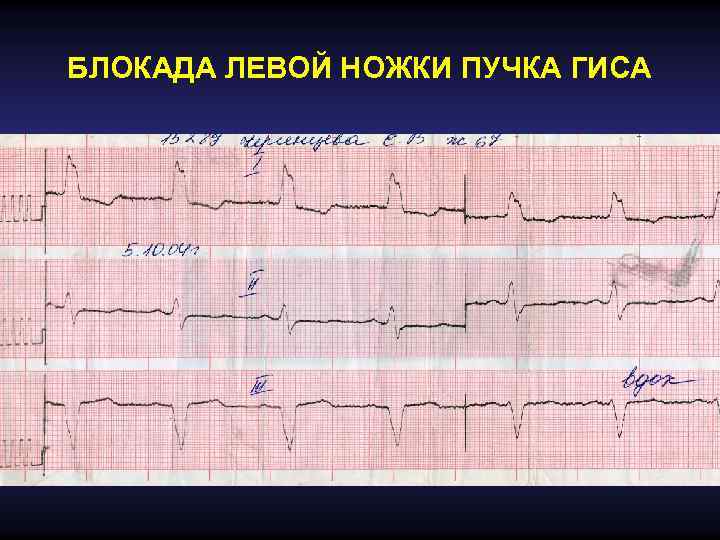 БЛОКАДА ЛЕВОЙ НОЖКИ ПУЧКА ГИСА 