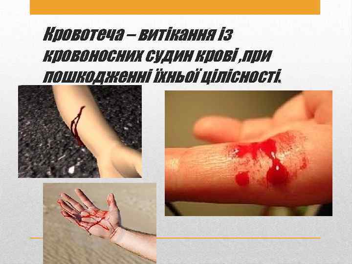 Кровотеча – витікання із кровоносних судин крові , при пошкодженні їхньої цілісності. 