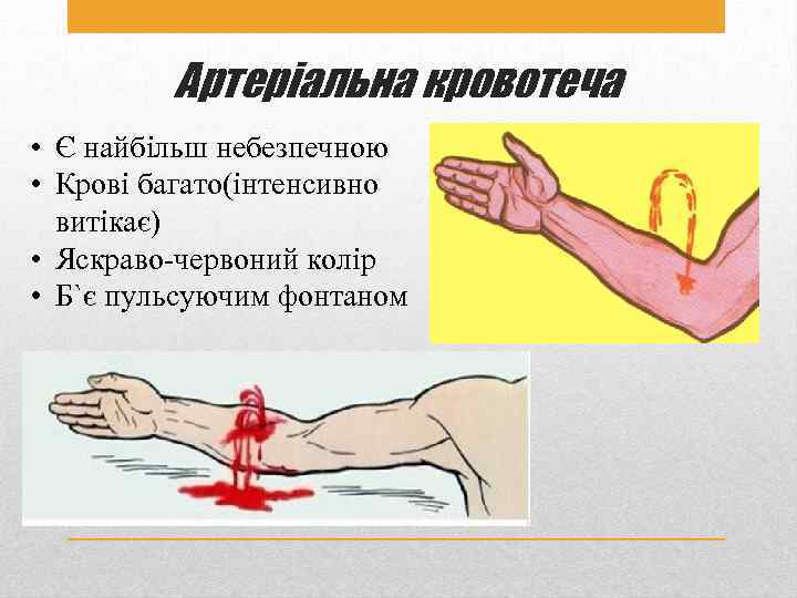 Артеріальна кровотеча • Є найбільш небезпечною • Крові багато(інтенсивно витікає) • Яскраво-червоний колір •