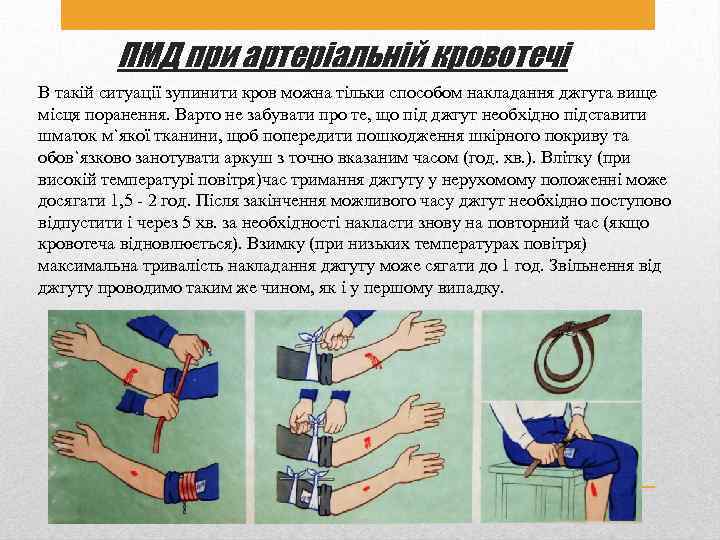 ПМД при артеріальній кровотечі В такій ситуації зупинити кров можна тільки способом накладання джгута