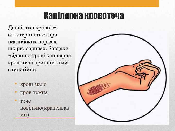 Капілярна кровотеча Даний тип кровотеч спостерігається при неглибоких порізах шкіри, садинах. Завдяки зсіданню крові